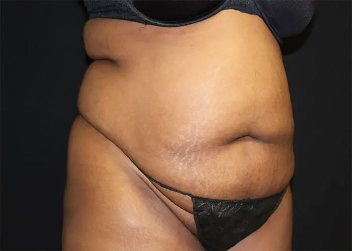 Abdominoplasty Before and After Pictures West Palm Beach, FL