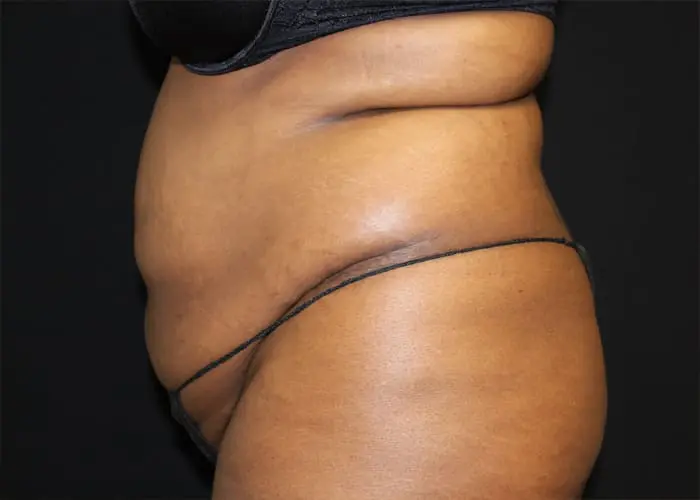 Abdominoplasty Before and After Pictures West Palm Beach, FL
