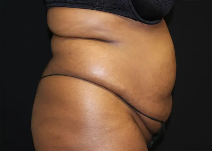 Abdominoplasty Before and After Pictures West Palm Beach, FL