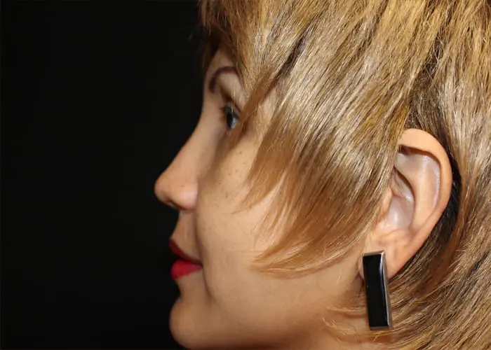 Rhinoplasty Before and After Pictures West Palm Beach, FL