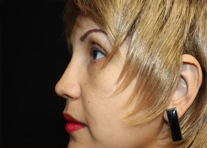 Rhinoplasty Before and After Pictures West Palm Beach, FL
