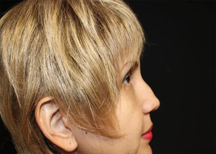 Rhinoplasty Before and After Pictures West Palm Beach, FL