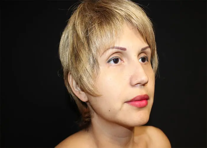 Rhinoplasty Before and After Pictures West Palm Beach, FL