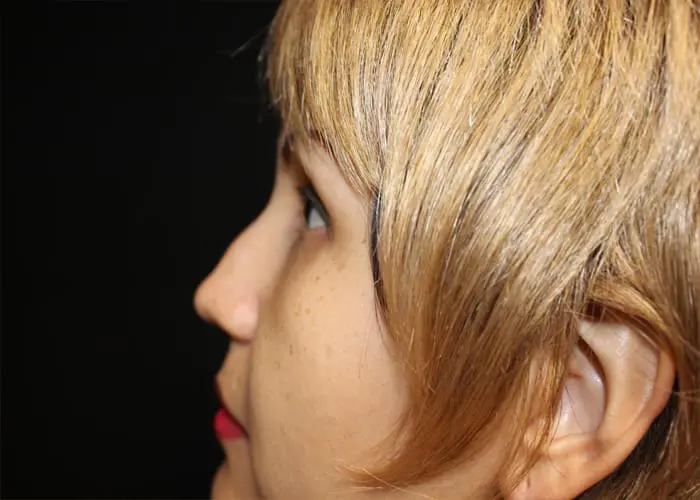 Rhinoplasty Before and After Pictures West Palm Beach, FL
