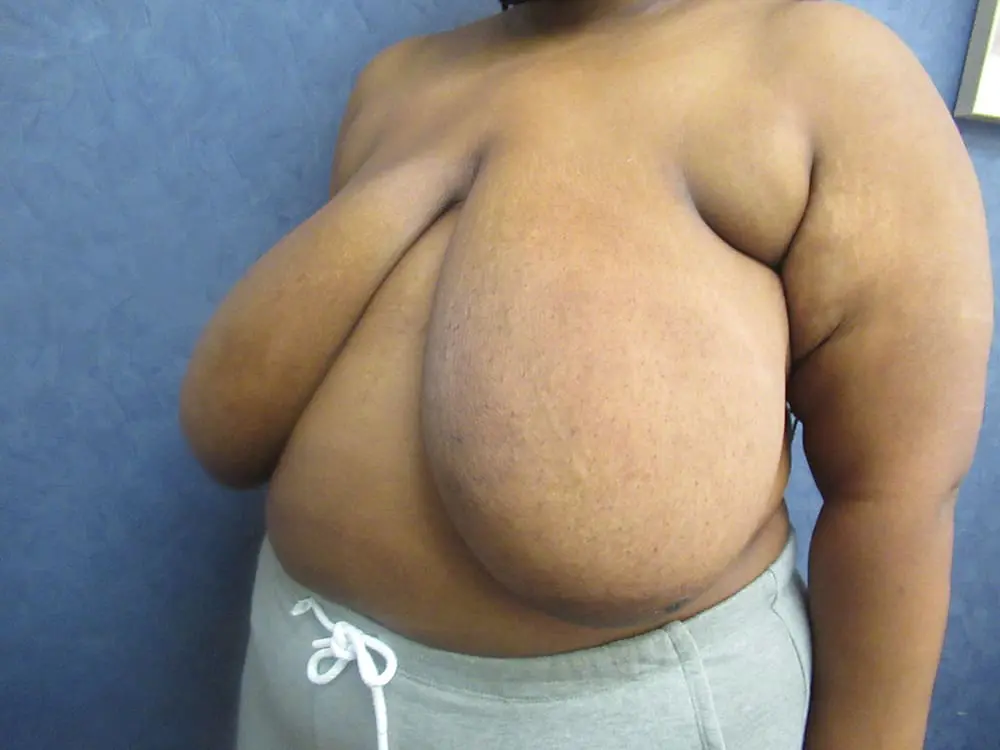 Breast Reduction Before and After Pictures West Palm Beach, FL