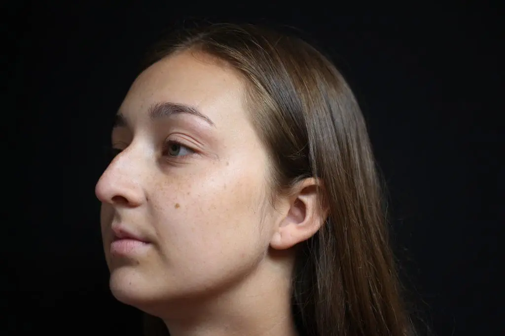 Rhinoplasty Before and After Pictures West Palm Beach, FL