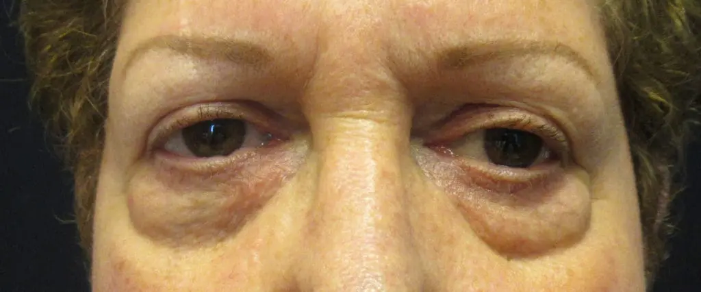 Blepharoplasty Before and After Pictures West Palm Beach, FL