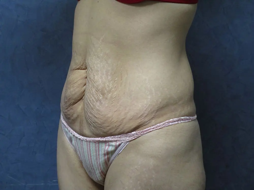 Abdominoplasty Before and After Pictures West Palm Beach, FL