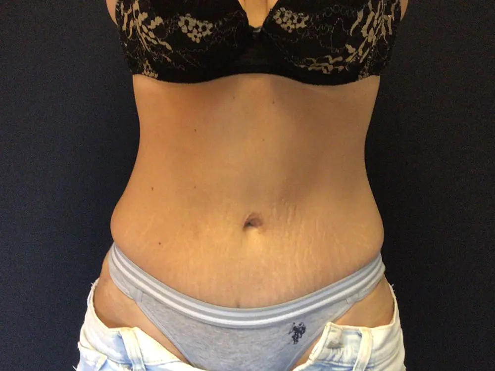 Abdominoplasty Before and After Pictures West Palm Beach, FL