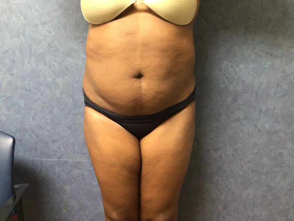 LIPOSUCTION BEFORE AND AFTER PICTURES IN WEST PALM BEACH, FL