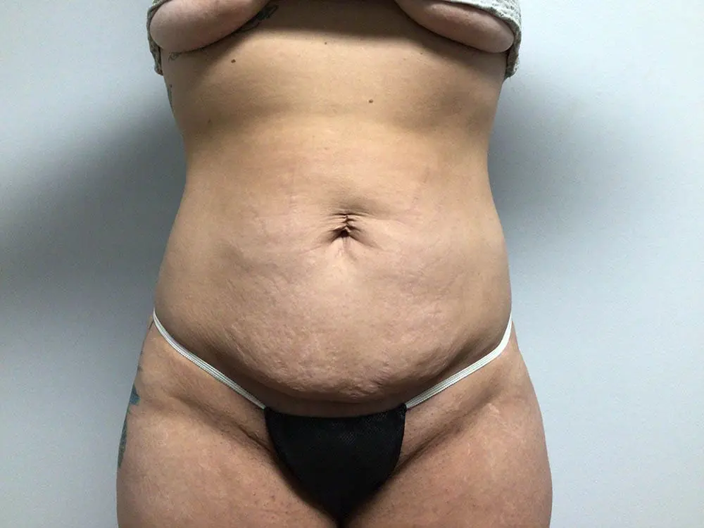 Abdominoplasty Before and After Pictures in West Palm Beach, FL