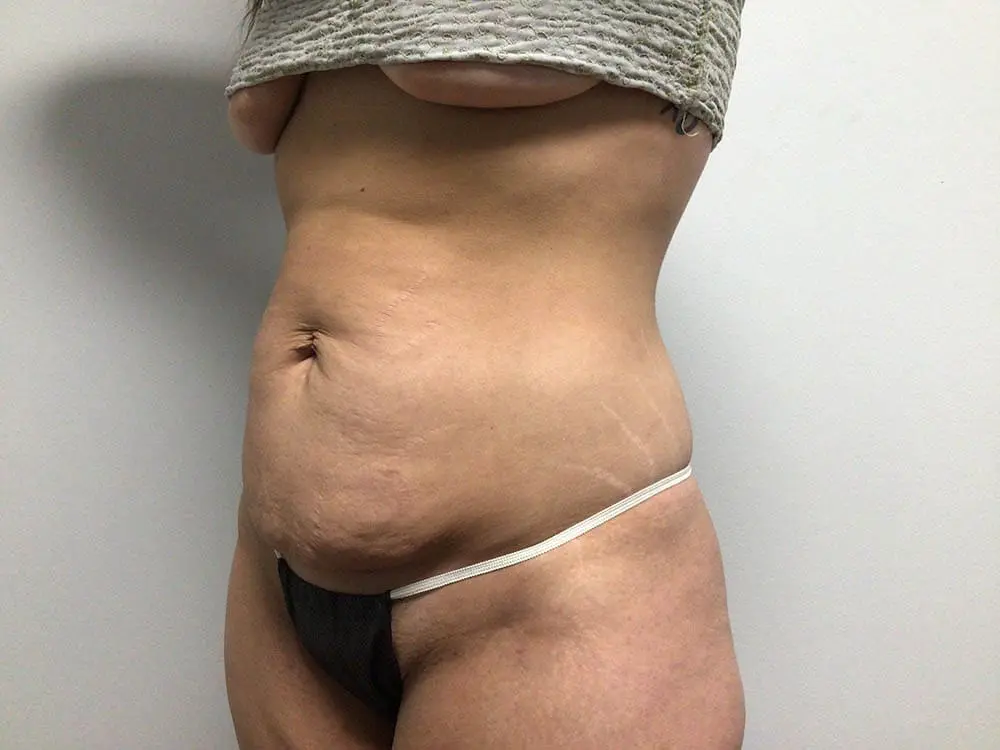 Abdominoplasty Before and After Pictures in West Palm Beach, FL