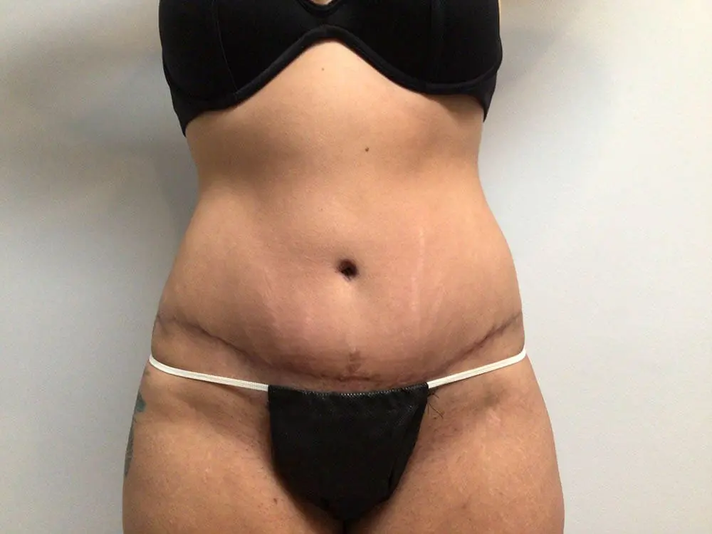 Abdominoplasty Before and After Pictures in West Palm Beach, FL