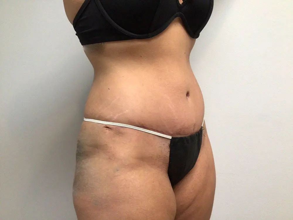 Abdominoplasty Before and After Pictures in West Palm Beach, FL