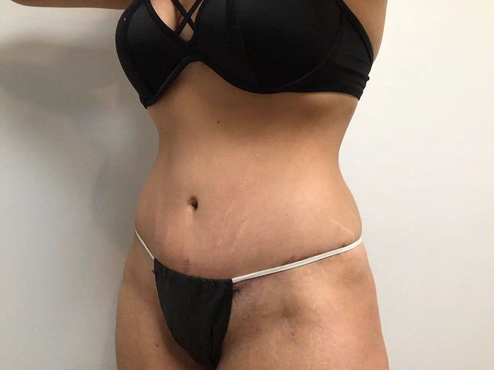 Abdominoplasty Before and After Pictures in West Palm Beach, FL