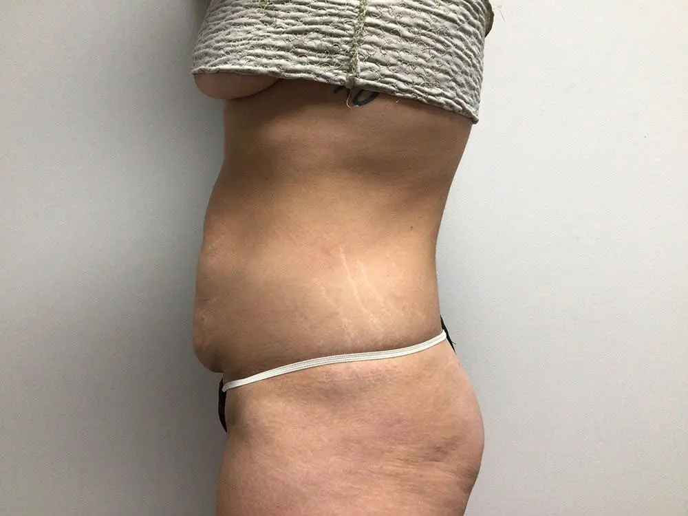 Abdominoplasty Before and After Pictures in West Palm Beach, FL