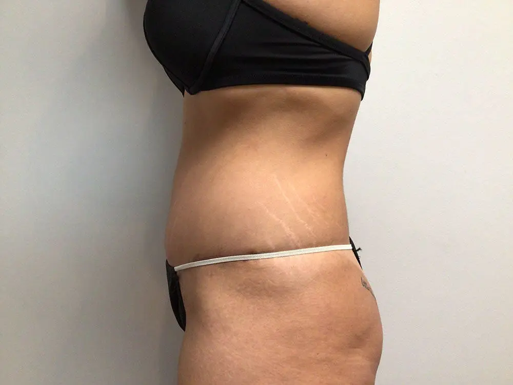 Abdominoplasty Before and After Pictures in West Palm Beach, FL