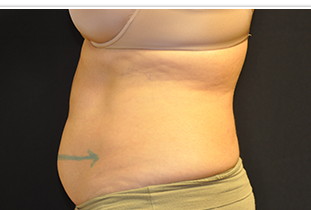 CoolSculpting Before and After Pictures West Palm Beach, FL
