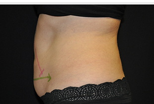 CoolSculpting Before and After Pictures West Palm Beach, FL