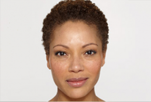 Botox Before and After Pictures West Palm Beach, FL