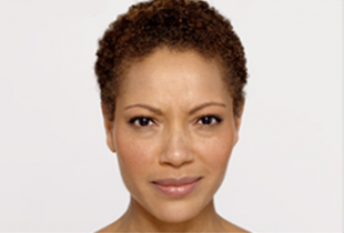 Botox Before and After Pictures West Palm Beach, FL