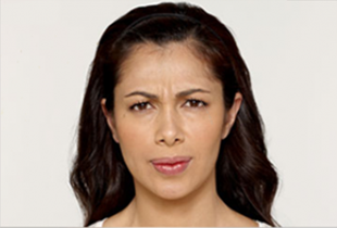 Botox Before and After Pictures West Palm Beach, FL