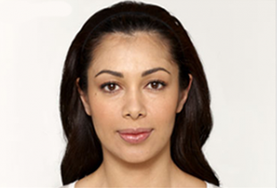 Botox Before and After Pictures West Palm Beach, FL