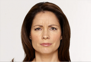 Botox Before and After Pictures West Palm Beach, FL