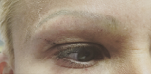 Permanent Makeup Before and After Pictures West Palm Beach, FL