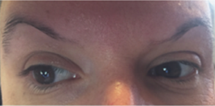 Permanent Makeup Before and After Pictures West Palm Beach, FL