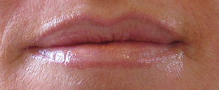 Lip Rejuvenation Before and After Pictures West Palm Beach, FL