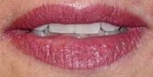Lip Rejuvenation Before and After Pictures West Palm Beach, FL