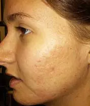 Microneedling with SkinPen Before and After Pictures West Palm Beach, FL
