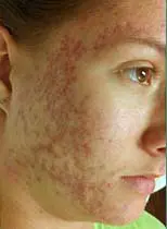 Microneedling with SkinPen Before and After Pictures West Palm Beach, FL