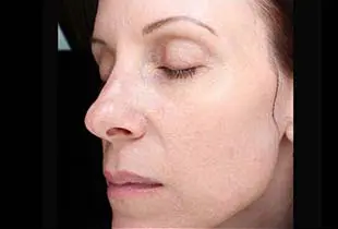 Microneedling with SkinPen Before and After Pictures West Palm Beach, FL