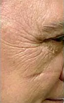 Microneedling with SkinPen Before and After Pictures West Palm Beach, FL