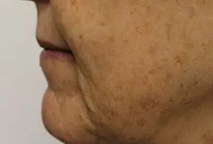 Microneedling with SkinPen Before and After Pictures West Palm Beach, FL
