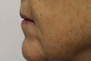Microneedling with SkinPen Before and After Pictures West Palm Beach, FL
