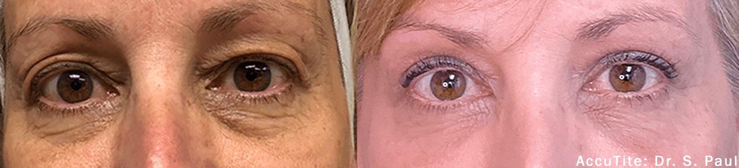 FaceTite, BodyTite and AccuTite in West Palm Beach and Jupiter, FL