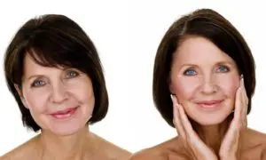 Facelift in West Palm Beach and Jupiter, FL