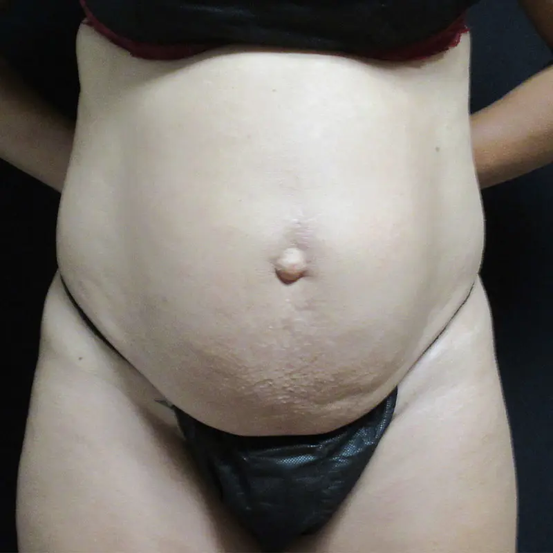 Abdominoplasty Before and After Pictures in West Palm Beach, FL