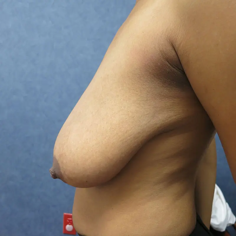 Breast Reduction Before and After Pictures in West Palm Beach, FL