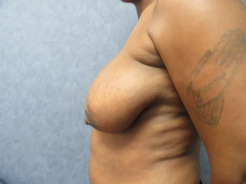 Breast Reduction Before and After Pictures in West Palm Beach, FL