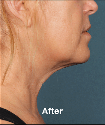 Kybella Before and After Pictures West Palm Beach, FL