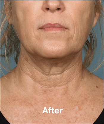 Kybella Before and After Pictures West Palm Beach, FL
