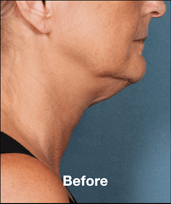 Kybella Before and After Pictures West Palm Beach, FL