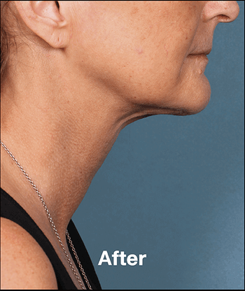 Kybella Before and After Pictures West Palm Beach, FL