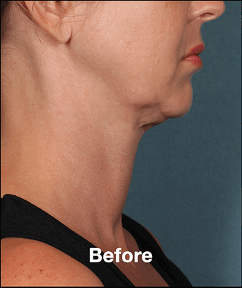 Kybella Before and After Pictures West Palm Beach, FL