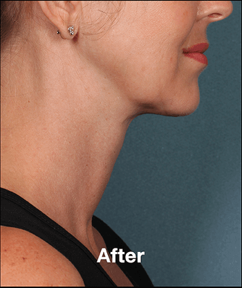 Kybella Before and After Pictures West Palm Beach, FL