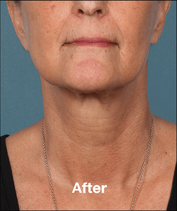 Kybella Before and After Pictures West Palm Beach, FL